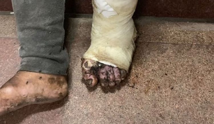 maggots on homeless mans leg