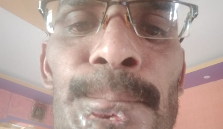 I Need Your Urgent Support For My Buccal Mucosa Cancer Treatment Ketto