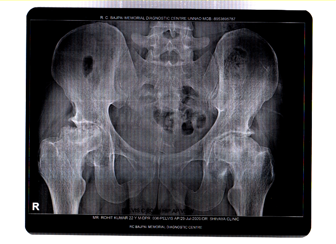 I Need Your Urgent Support For My Avascular Necrosis Of The Hip