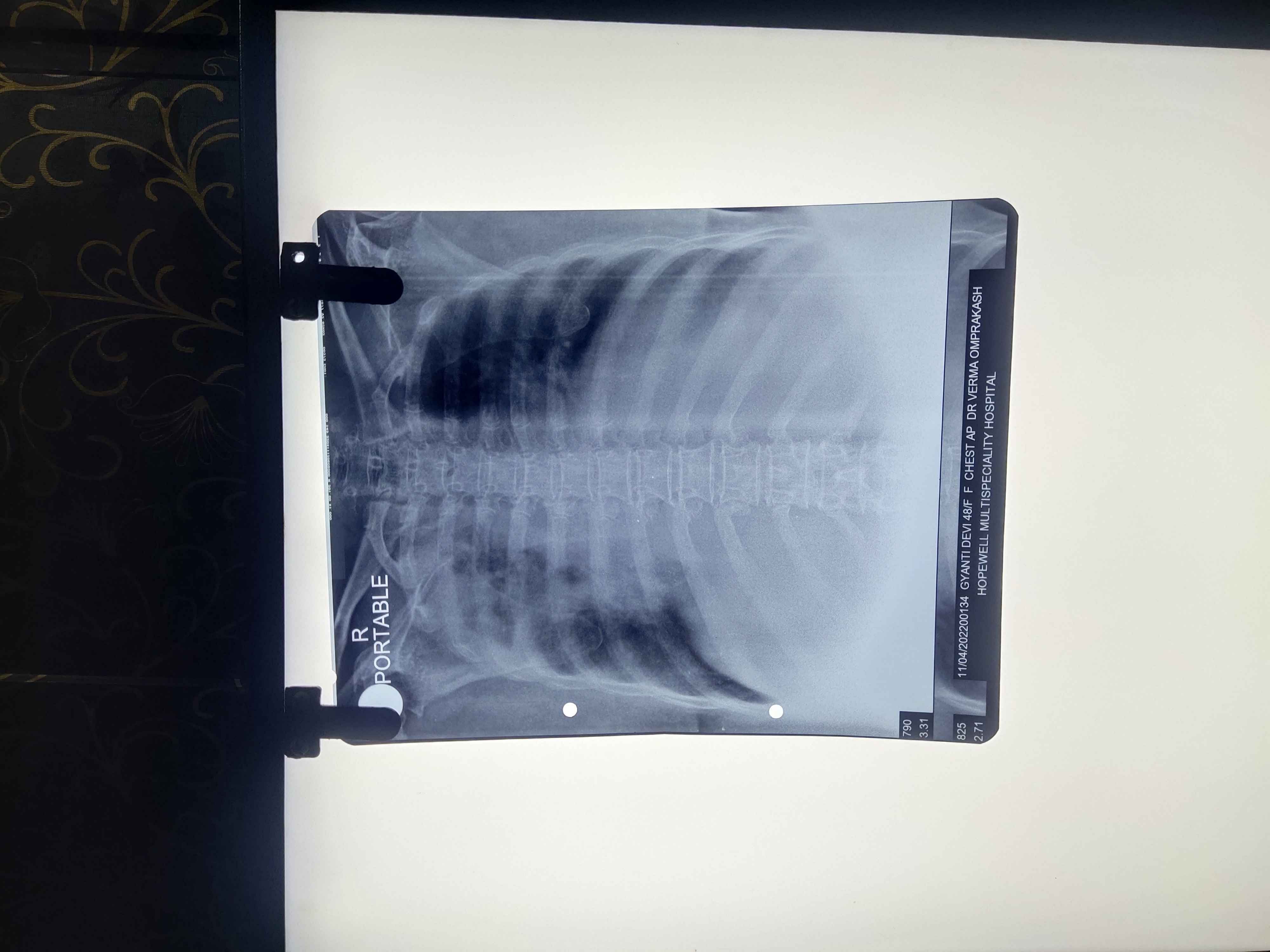 My Mother Is Suffering From Chest Infection. We Need Your Help To