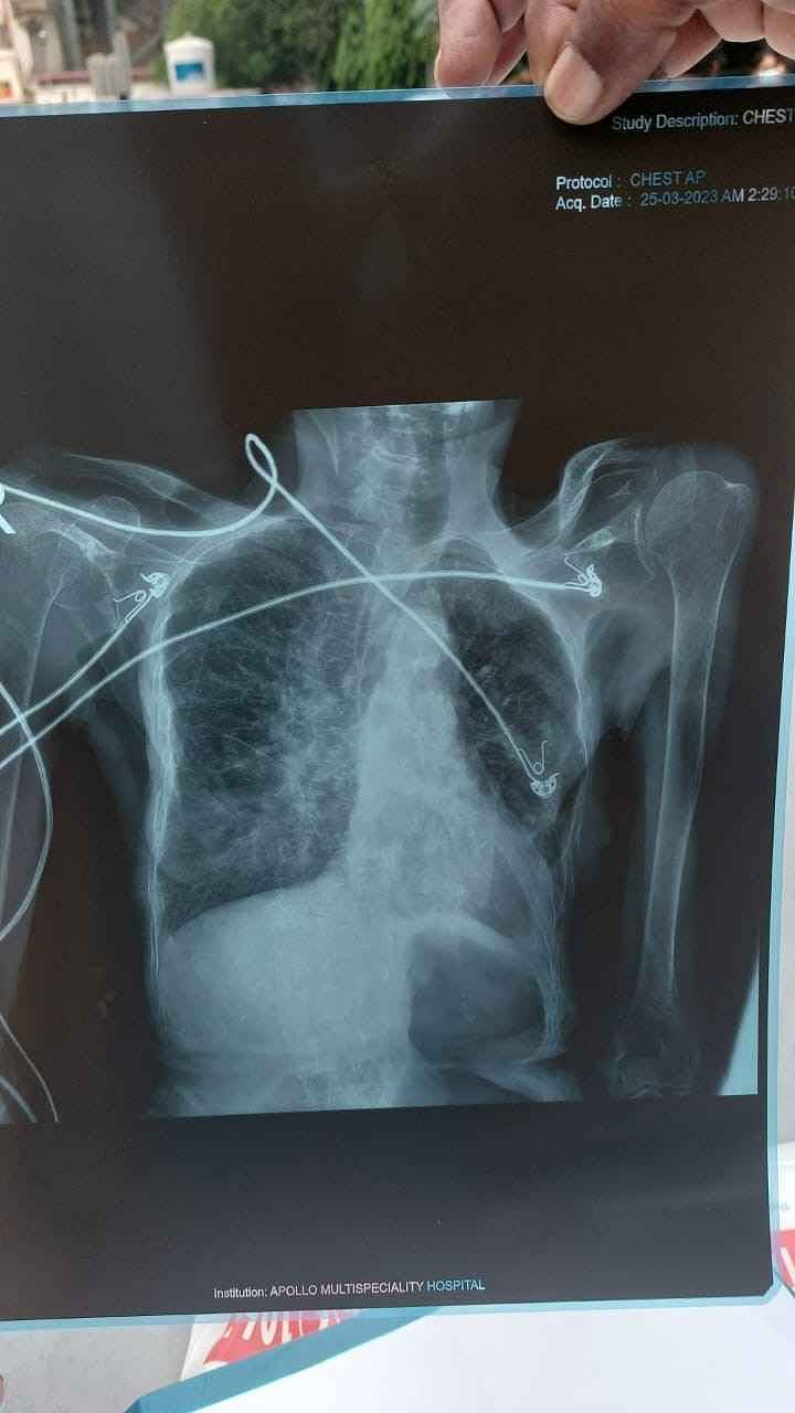 My Mother Is Suffering From Chest Infection. We Need Your Help To