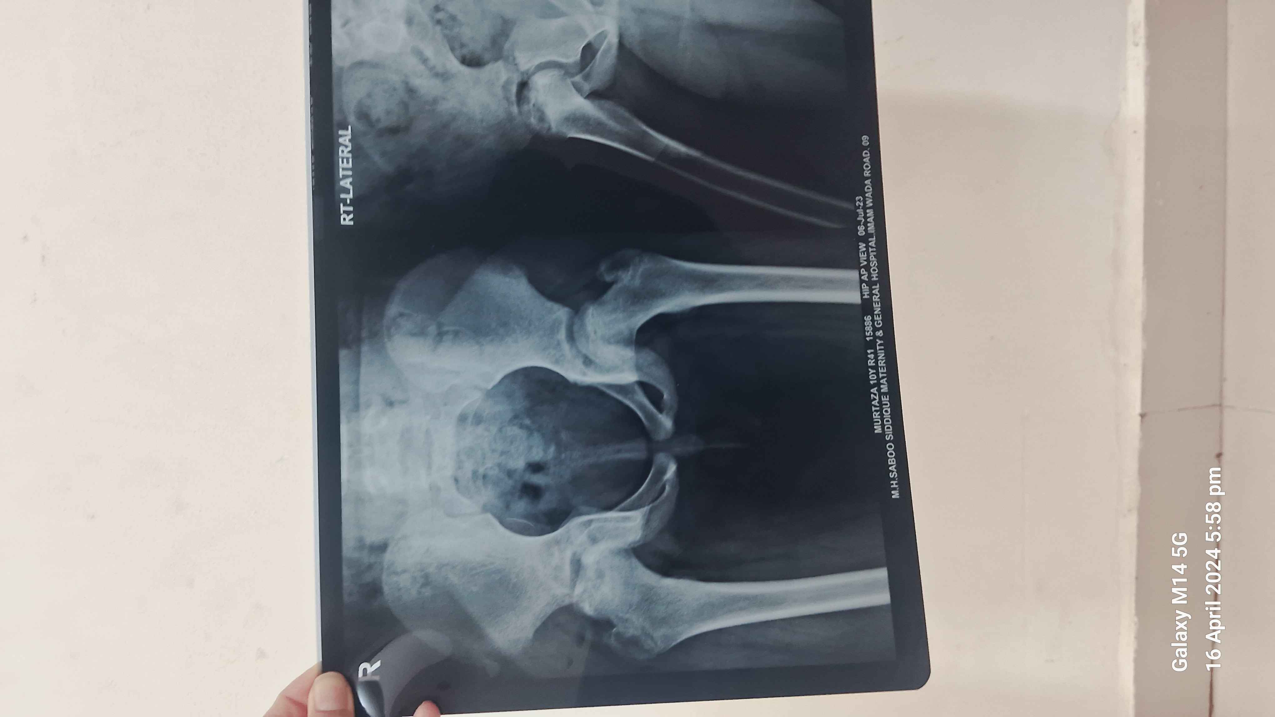 My Son Is Suffering From Avascular Necrosis Of The Hip  Osteonecrosis 