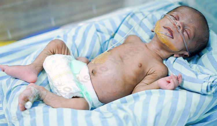 help-my-premature-baby-get-the-treatment-needed-to-survive-ketto